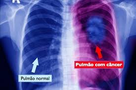 Cancer de Pulmão